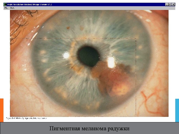 Пигментная меланома радужки 