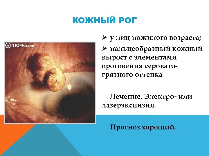 КОЖНЫЙ РОГ Ø у лиц пожилого возраста; Ø пальцеобразный кожный вырост с элементами ороговения