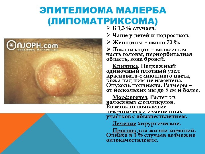 ЭПИТЕЛИОМА МАЛЕРБА (ЛИПОМАТРИКСОМА) Ø В 1, 3 % случаев. Ø Чаще у детей и