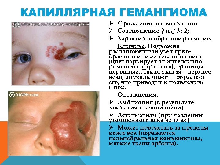 КАПИЛЛЯРНАЯ ГЕМАНГИОМА Ø С рождения и с возрастом; Ø Соотношение ♀ и ♂ 3