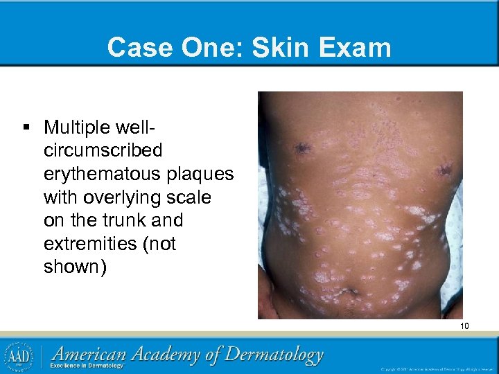 Case One: Skin Exam § Multiple wellcircumscribed erythematous plaques with overlying scale on the
