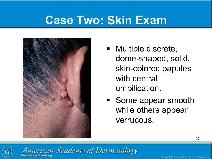 Case Two: Skin Exam § Multiple discrete, dome-shaped, solid, skin-colored papules with central umbilication.