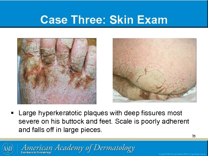 Case Three: Skin Exam § Large hyperkeratotic plaques with deep fissures most severe on