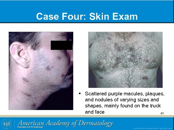Case Four: Skin Exam § Scattered purple macules, plaques, and nodules of varying sizes