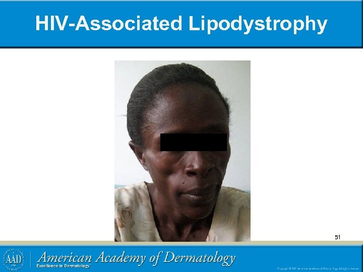 HIV-Associated Lipodystrophy 51 