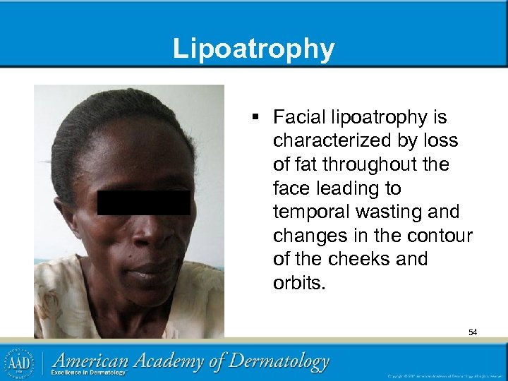 Lipoatrophy § Facial lipoatrophy is characterized by loss of fat throughout the face leading