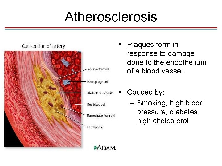 Atherosclerosis • Plaques form in response to damage done to the endothelium of a