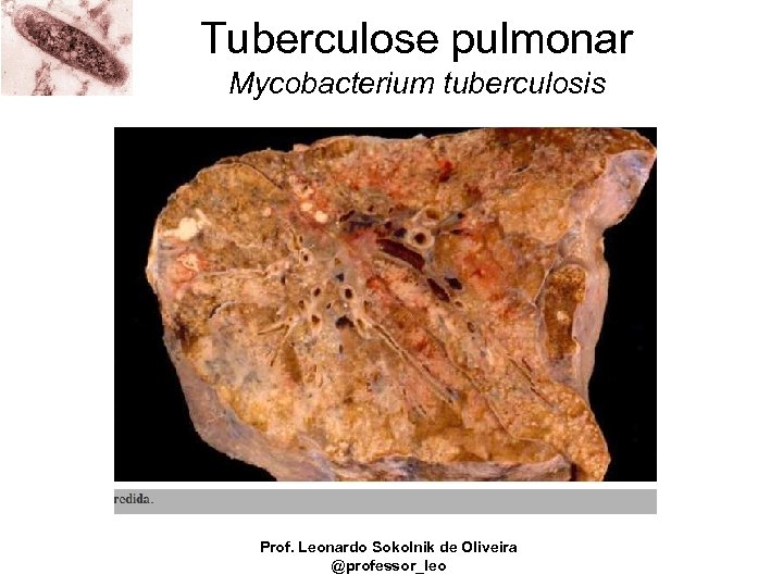 Tuberculose pulmonar Mycobacterium tuberculosis Prof. Leonardo Sokolnik de Oliveira @professor_leo 