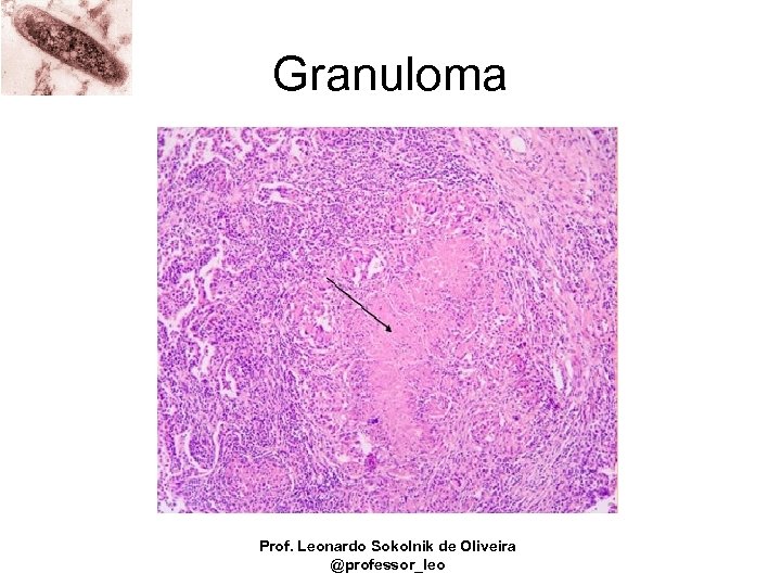 Granuloma Prof. Leonardo Sokolnik de Oliveira @professor_leo 