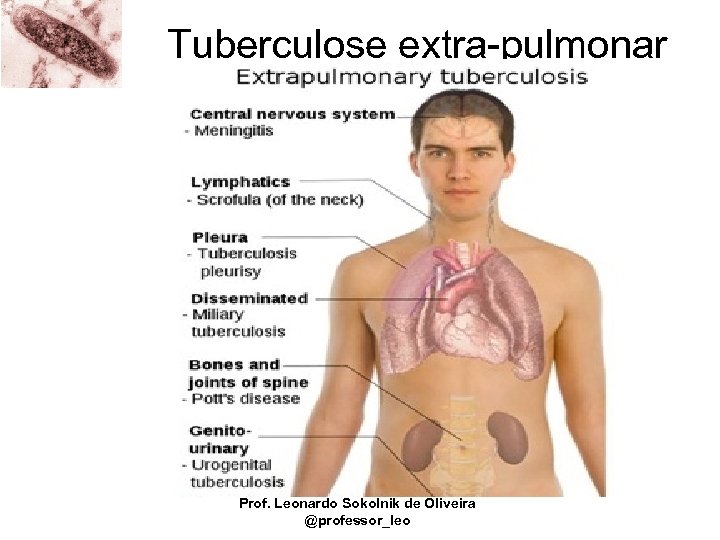 Tuberculose extra-pulmonar Prof. Leonardo Sokolnik de Oliveira @professor_leo 