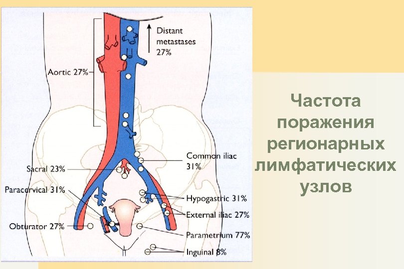 Частота поражения регионарных лимфатических узлов 