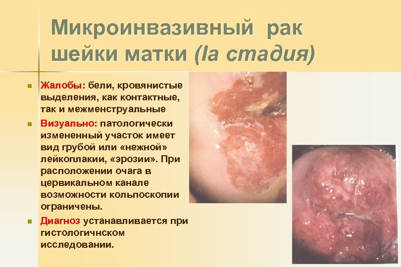 Микроинвазивный рак шейки матки (Ia стадия) n n n Жалобы: бели, кровянистые выделения, как