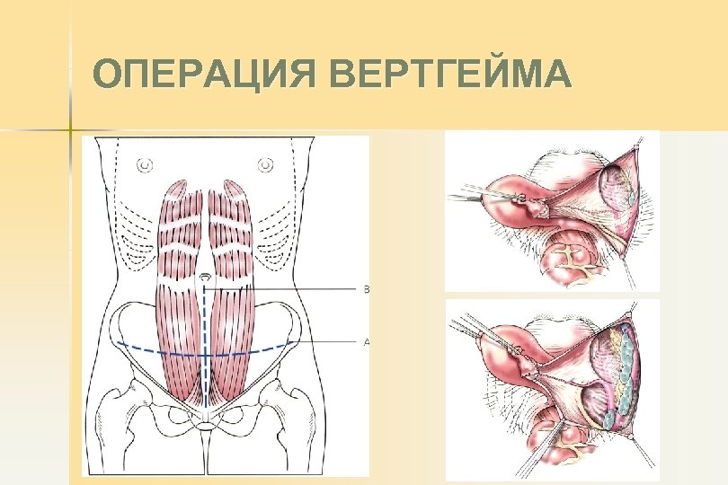 ОПЕРАЦИЯ ВЕРТГЕЙМА 