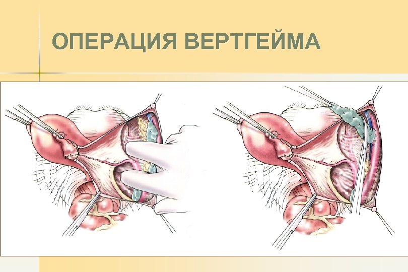 ОПЕРАЦИЯ ВЕРТГЕЙМА 