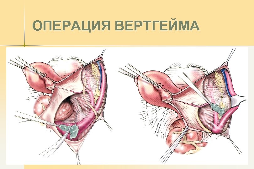 ОПЕРАЦИЯ ВЕРТГЕЙМА 