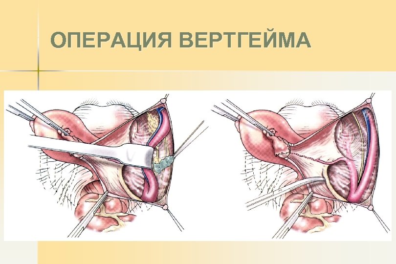 ОПЕРАЦИЯ ВЕРТГЕЙМА 