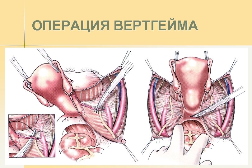 ОПЕРАЦИЯ ВЕРТГЕЙМА 