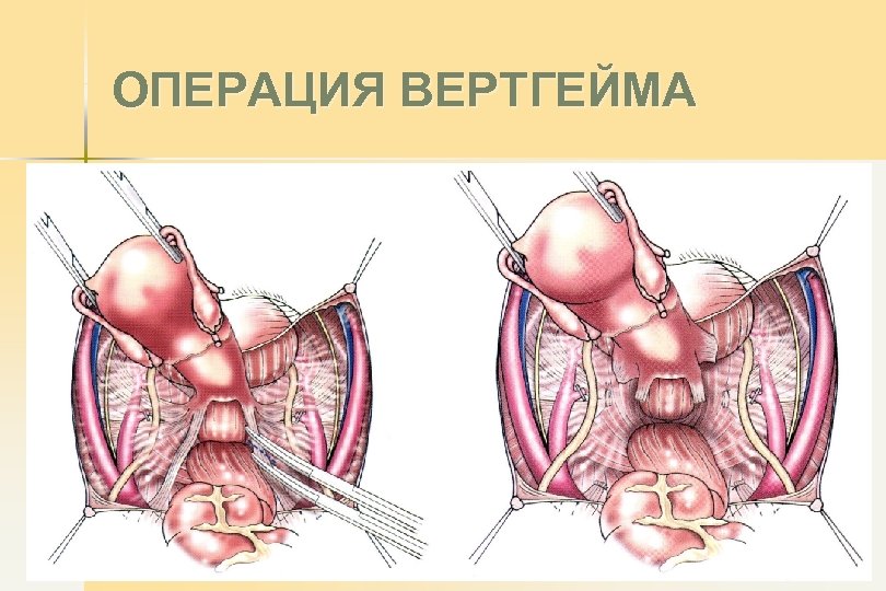 ОПЕРАЦИЯ ВЕРТГЕЙМА 