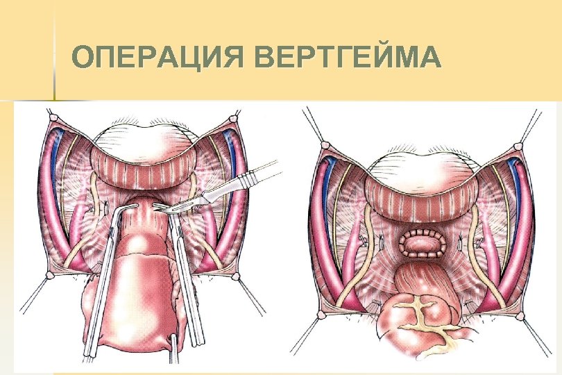 ОПЕРАЦИЯ ВЕРТГЕЙМА 