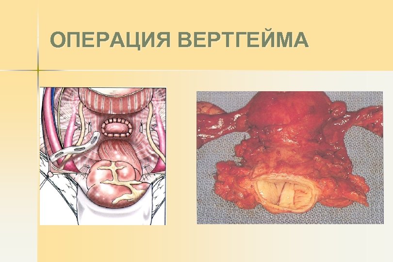 ОПЕРАЦИЯ ВЕРТГЕЙМА 