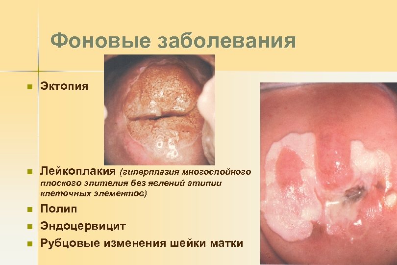 Фоновые заболевания n Эктопия n Лейкоплакия (гиперплазия многослойного плоского эпителия без явлений атипии клеточных