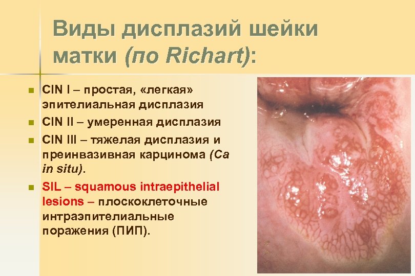 Виды дисплазий шейки матки (по Richart): n n CIN I – простая, «легкая» эпителиальная