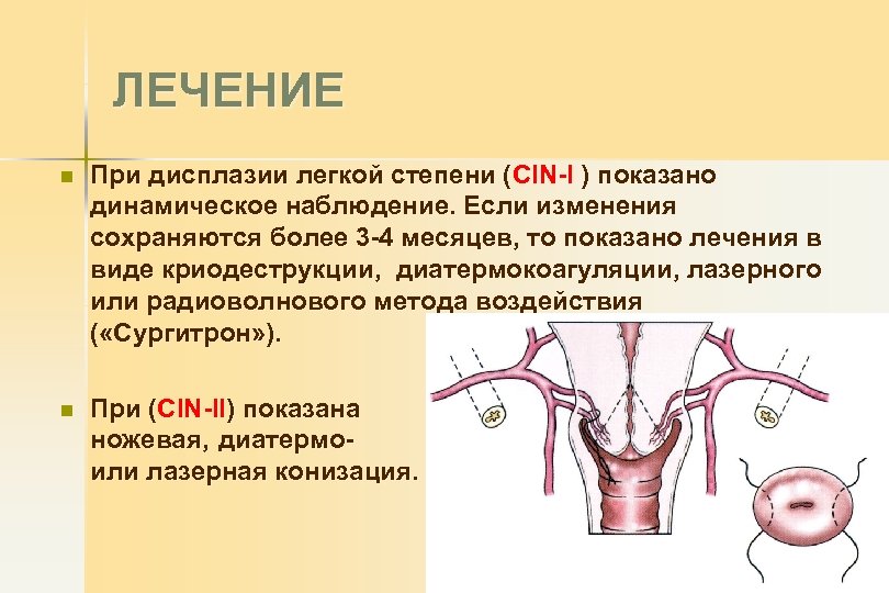 Схема лечения дисплазии шейки матки 1 степени