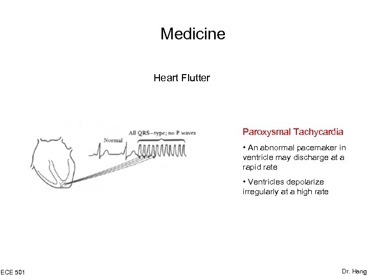 Medicine Heart Flutter Paroxysmal Tachycardia • An abnormal pacemaker in ventricle may discharge at