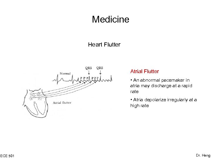 Medicine Heart Flutter Atrial Flutter • An abnormal pacemaker in atria may discharge at