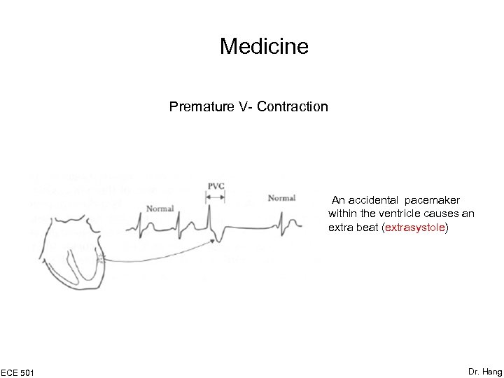 Medicine Premature V- Contraction An accidental pacemaker within the ventricle causes an extra beat