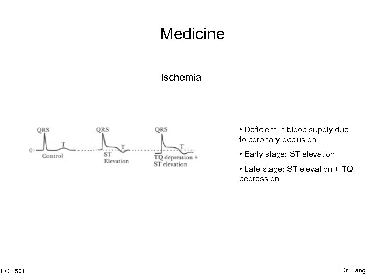 Medicine Ischemia • Deficient in blood supply due to coronary occlusion • Early stage: