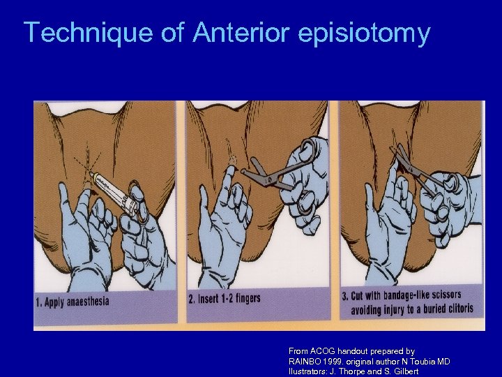 Technique of Anterior episiotomy From ACOG handout prepared by RAINBO 1999. original author N