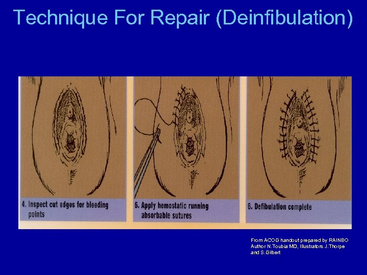 Technique For Repair (Deinfibulation) From ACOG handout prepared by RAINBO Author N. Toubia MD,