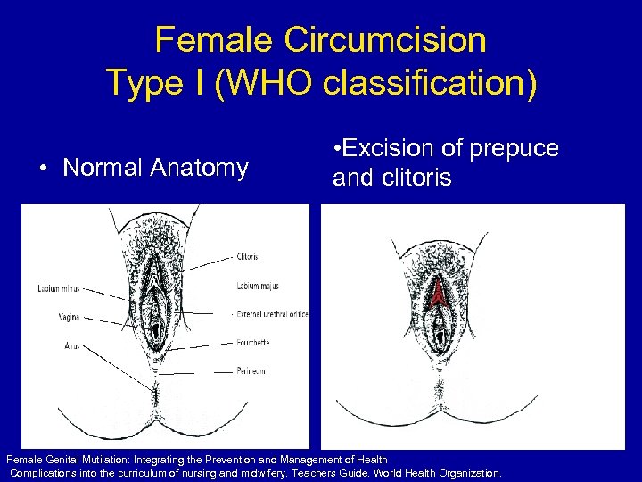 Female Circumcision Type I (WHO classification) • Normal Anatomy • Excision of prepuce and