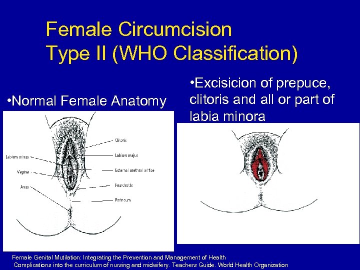 Female Circumcision Type II (WHO Classification) • Normal Female Anatomy • Excisicion of prepuce,
