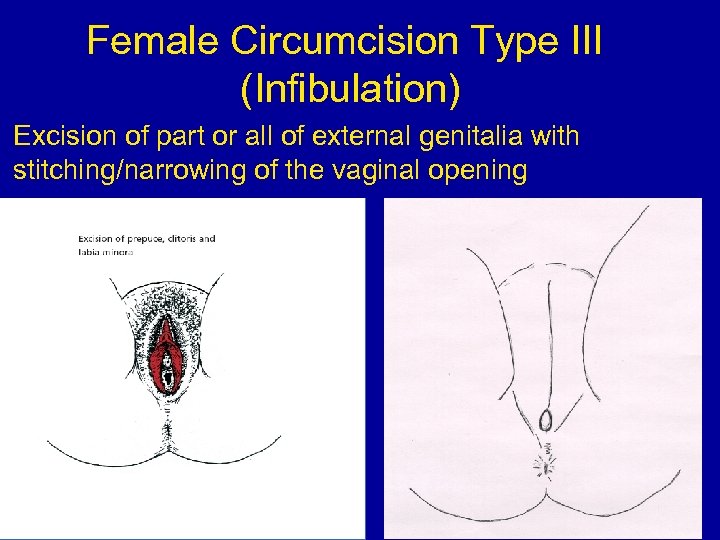 Female Circumcision Type III (Infibulation) Excision of part or all of external genitalia with