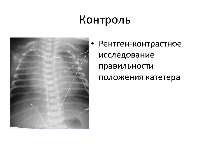 Контроль • Рентген-контрастное исследование правильности положения катетера 