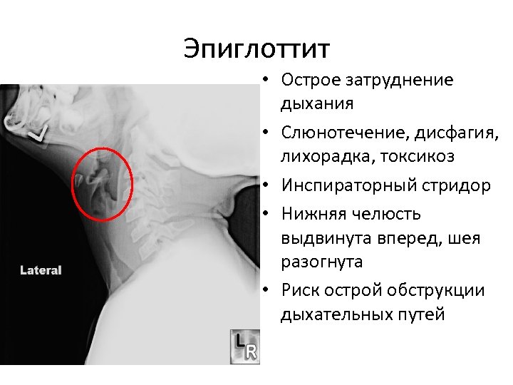 Эпиглоттит • Острое затруднение дыхания • Слюнотечение, дисфагия, лихорадка, токсикоз • Инспираторный стридор •