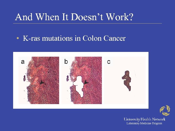 And When It Doesn’t Work? • K-ras mutations in Colon Cancer Laboratory Medicine Program