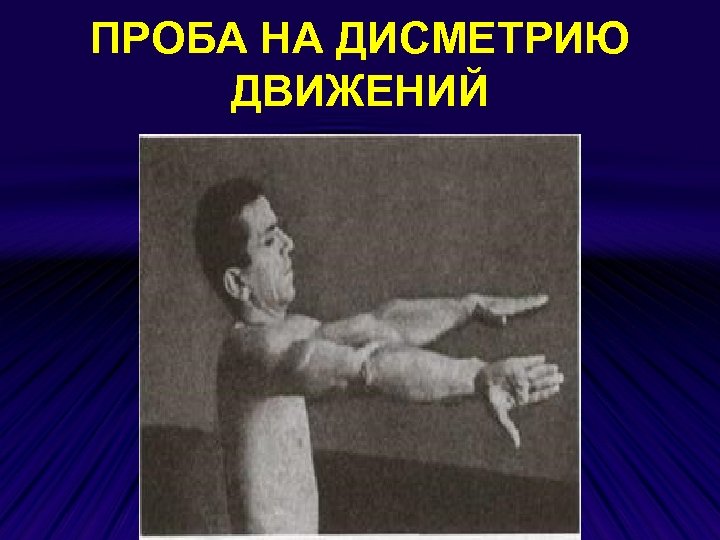 ПРОБА НА ДИСМЕТРИЮ ДВИЖЕНИЙ 