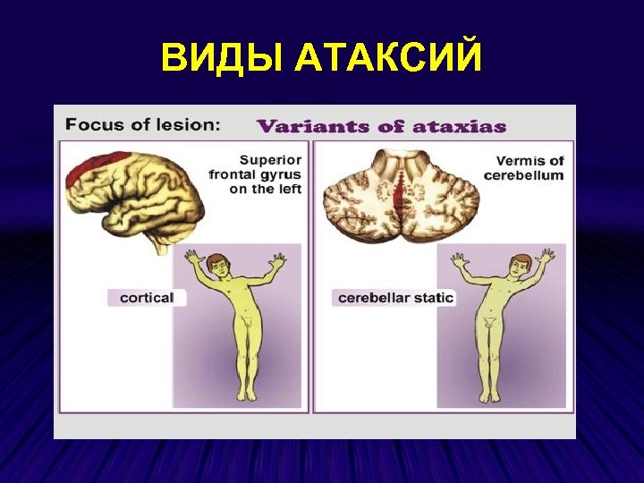 ВИДЫ АТАКСИЙ 