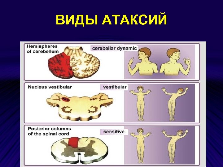 ВИДЫ АТАКСИЙ 