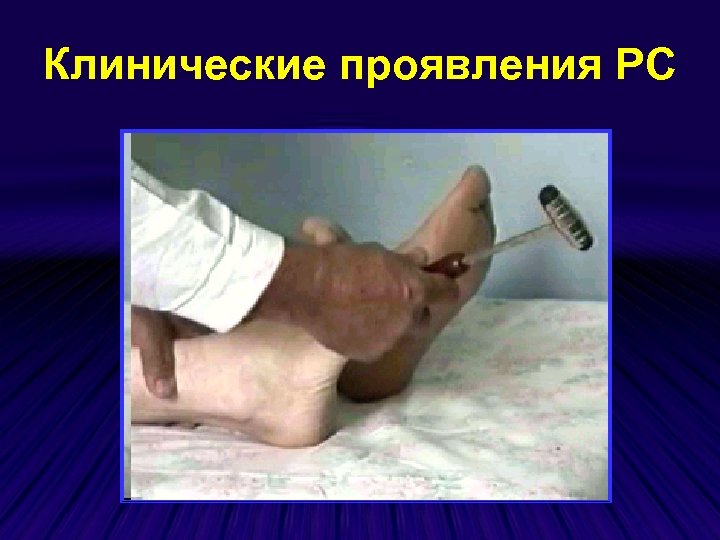 Клинические проявления РС 