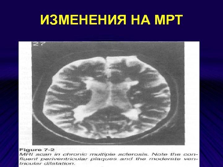 ИЗМЕНЕНИЯ НА МРТ 