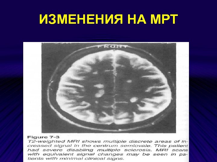 ИЗМЕНЕНИЯ НА МРТ 