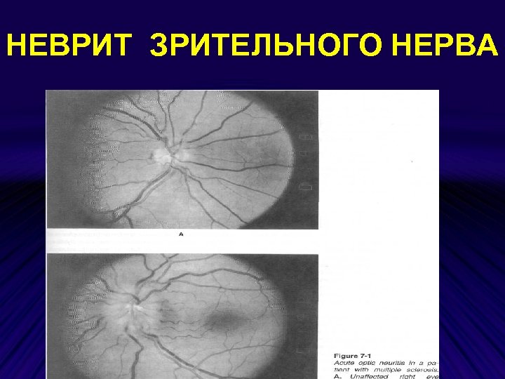 НЕВРИТ ЗРИТЕЛЬНОГО НЕРВА 