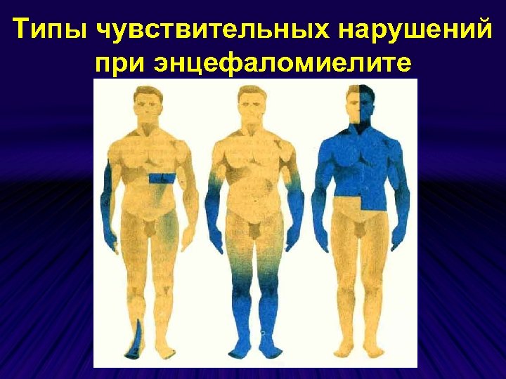 Типы чувствительных нарушений при энцефаломиелите 