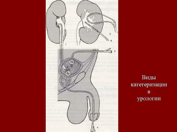 Виды катетеризации в урологии 