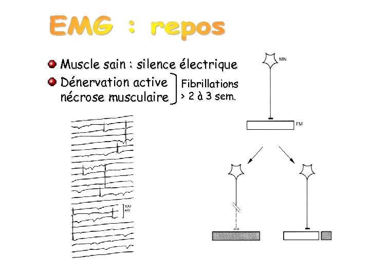 Muscle sain : silence électrique Dénervation active Fibrillations nécrose musculaire > 2 à 3