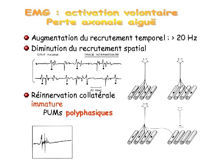 Augmentation du recrutement temporel : > 20 Hz Diminution du recrutement spatial Réinnervation collatérale